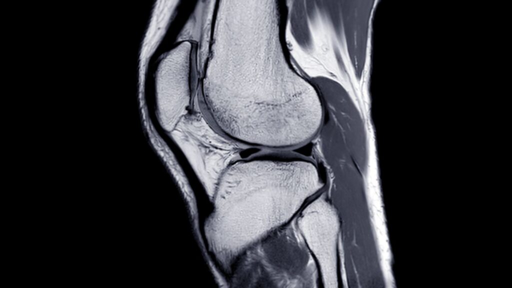 Resonancia Magnética de Rodilla