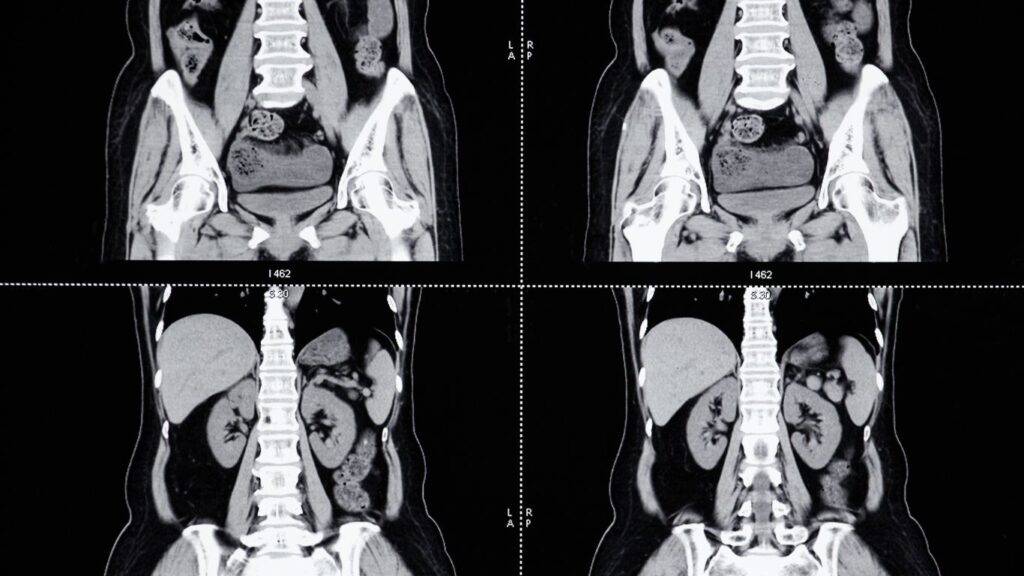 Resonancia Magnética de Abdomen